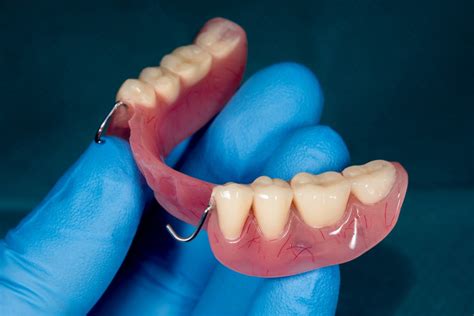 resin vs metal partial dentures